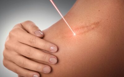 Innovations: Le Laser Urgotouch améliore vos cicatrices