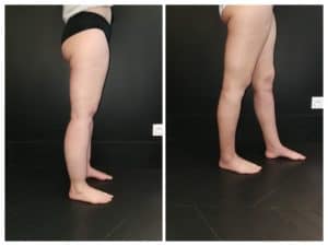 lipoedème et liposuccion WAL jambes