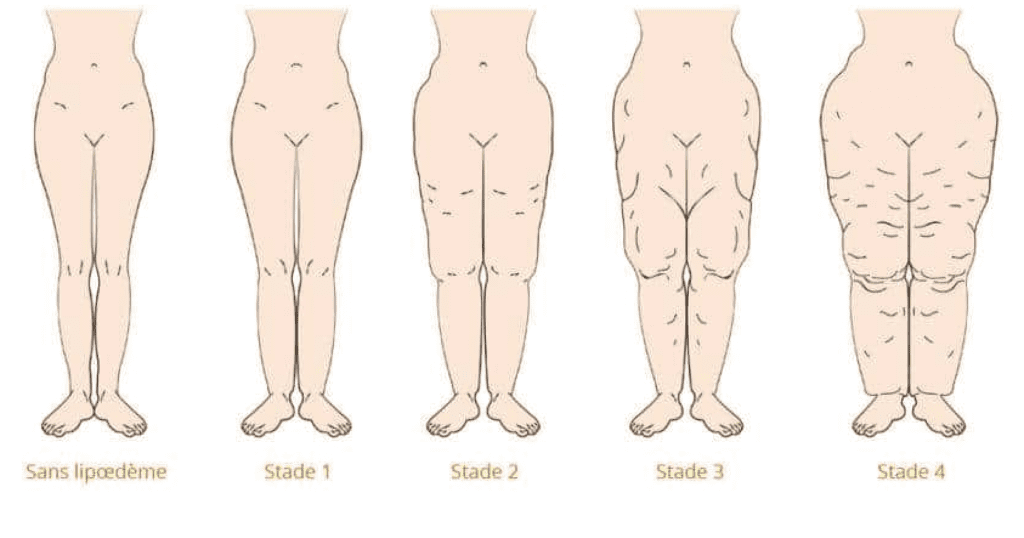 Lipoedème aux jambes : symptômes, traitement avec la pressothérapie – JOLT™  FR - OTG