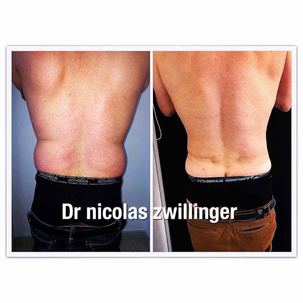 chirurgie esthétique homme liposuccion du dos homme par le Dr Nicolas Zwillinger